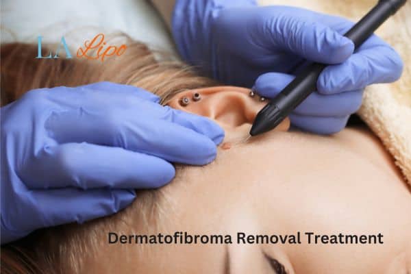 Dermatofibroma Removal Treatment Holme Chapel