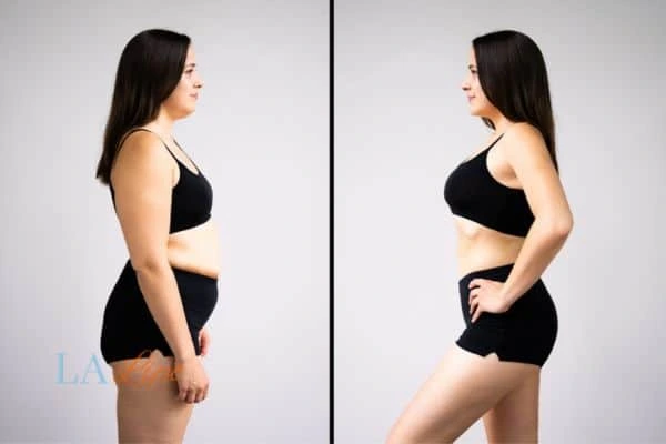 image of woman before and after results of LA-EMS Body Sculpting Holme Chapel to help treat Diastasis recti
