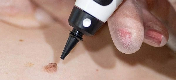skin tag removal using cryopen Holme Chapel