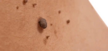 image of a skin tag Holme Chapel