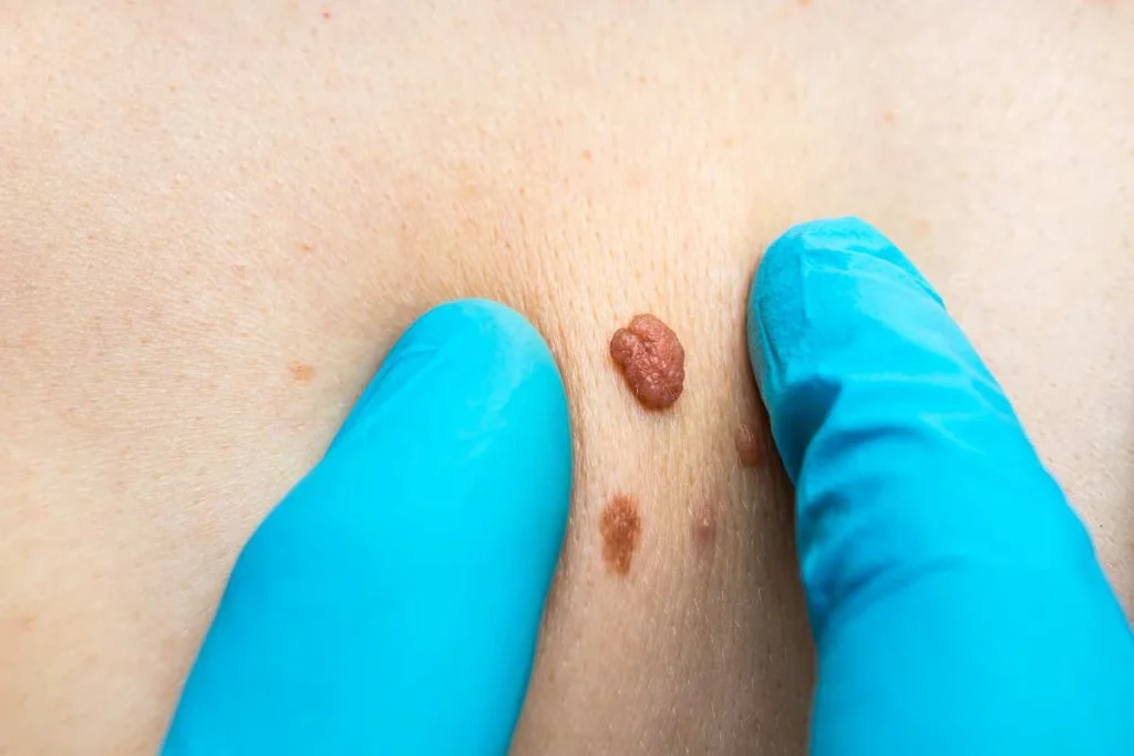 Consultant examining a skin tag Holme Chapel