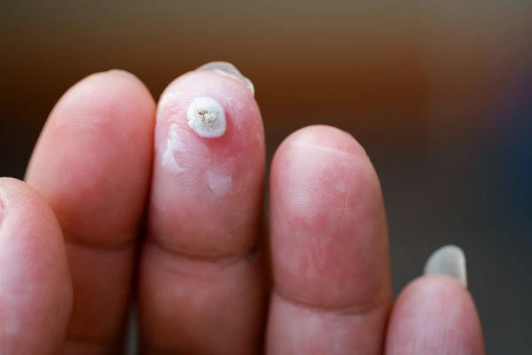wart on person finger - cryotherapy to treat from LA LIPO Holme Chapel