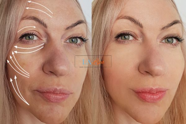 Morpheus 8 results Holme Chapel face lift.