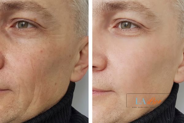 See the amazing results of Morpheus8 Treatment Holme Chapel!